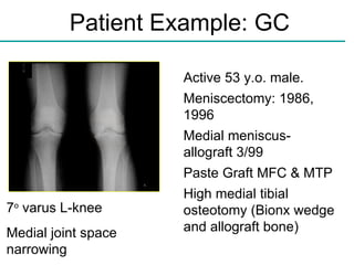 Patient Example: GC 7 o  varus L-knee Medial joint space narrowing Active 53 y.o. male. Meniscectomy: 1986, 1996 Medial meniscus-allograft 3/99  Paste Graft MFC & MTP High medial tibial osteotomy (Bionx wedge and allograft bone) 
