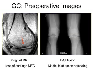 GC: Preoperative Images Sagittal MRI Loss of cartilage MFC PA Flexion Medial joint space narrowing 
