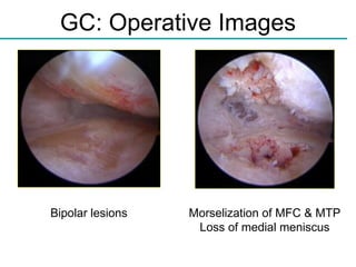 GC: Operative Images A B Bipolar   lesions Morselization of MFC & MTP Loss of medial meniscus 