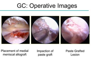 GC: Operative Images A B C Placement of medial meniscal allograft Impaction of paste graft Paste Grafted Lesion 