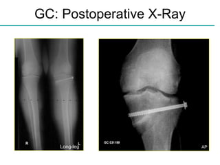 GC: Postoperative X-Ray Long-leg AP 