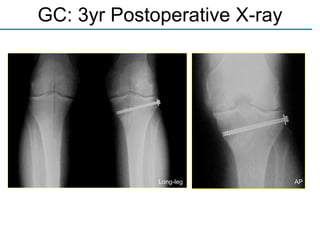 GC: 3yr Postoperative X-ray AP Long-leg 