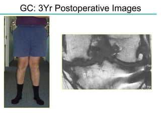 GC: 3Yr Postoperative Images 3 Years post-op L-medial allograft, osteotomy, & paste graft 