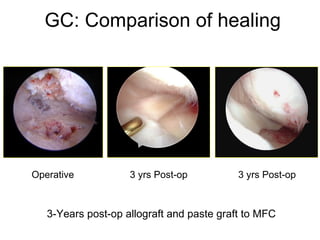 GC: Comparison of healing 3-Years post-op allograft and paste graft to MFC Operative 3 yrs Post-op 3 yrs Post-op 