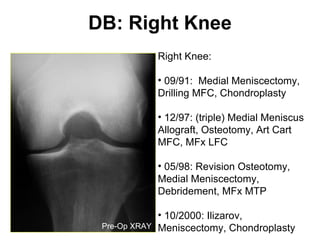 DB: Right Knee Right Knee:  09/91:  Medial Meniscectomy, Drilling MFC, Chondroplasty 12/97: (triple) Medial Meniscus Allograft, Osteotomy, Art Cart MFC, MFx LFC 05/98: Revision Osteotomy, Medial Meniscectomy, Debridement, MFx MTP 10/2000: Ilizarov, Meniscectomy, Chondroplasty Pre-Op XRAY 