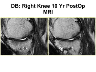 DB: Right Knee 10 Yr PostOp MRI 