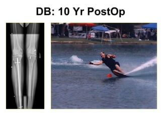 DB: 10 Yr PostOp 63 YO, Tegner = 6, Skis 30+ days/yr, Snow skis 50+ days/yr. 