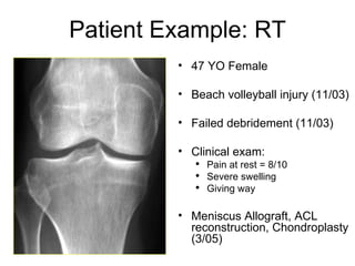 47 YO Female Beach volleyball injury (11/03) Failed debridement (11/03) Clinical exam: Pain at rest = 8/10 Severe swelling  Giving way Meniscus Allograft, ACL reconstruction, Chondroplasty (3/05) Patient Example: RT 