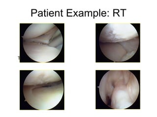 Torn medial meniscus MFC chondral lesion LFC chondral lesion Torn ACL Patient Example: RT 