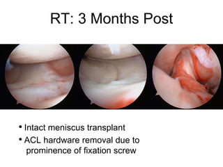Intact meniscus transplant ACL hardware removal due to   prominence of fixation screw RT: 3 Months Post 