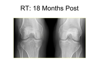 Excellent joint space, intact meniscus allograft and ACL, but right knee clicking and catching RT: 18 Months Post 
