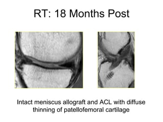 Intact meniscus allograft and ACL with diffuse thinning of patellofemoral cartilage RT: 18 Months Post 
