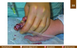 #bedahplastikntt	 @robertusarian	
arian9677@gmail.com	 @eanplastic	
20	
 