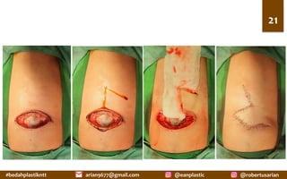 #bedahplastikntt	 @robertusarian	
arian9677@gmail.com	 @eanplastic	
21	
 