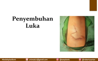 #bedahplastikntt	 @robertusarian	
arian9677@gmail.com	 @eanplastic	
Penyembuhan	
Luka	
 