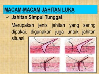 Menjahit Luka Dengan Bermacam Teknik | PPTX