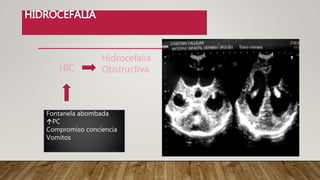 HIC
Hidrocefalia
Obstructiva
Fontanela abombada
PC
Compromiso conciencia
Vomitos
 