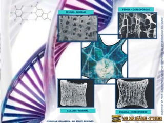 FEMUR - OSTEOPOROSE
                 FEMUR - NORMAL




                                                                     COURTESY OF PROF. ALAN BOYDE ATLAS OF OSTEOPOROSIS J.C. STEVENSON AND M.S. MARSH
                  COLUNA- NORMAL
                                             COLUNA- OSTEOPORESE



©2006 VAN DER HAAGEN – ALL RIGHTS RESERVED
 