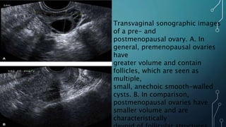 Transvaginal sonographic images
of a pre- and
postmenopausal ovary. A. In
general, premenopausal ovaries
have
greater volume and contain
follicles, which are seen as
multiple,
small, anechoic smooth-walled
cysts. B. In comparison,
postmenopausal ovaries have
smaller volume and are
characteristically
 