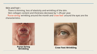 Skin and hair :
There is thinning, loss of elasticity and wrinkling of the skin.
Skin collagen content and thickness decrease by 1–2% per year.
‘Purse string’ wrinkling around the month and ‘crow feet’ around the eyes are the
characteristics.
Purse String
Wrinkling
Crow Feet Wrinkling
 
