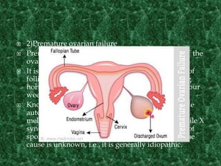  2)Premature ovarian failure
 Premature ovarian failure (POF) is the cessation of the
ovarian function before the age of 40 years.
 It is diagnosed or confirmed by high blood levels of
follicle stimulating hormone (FSH) and luteinizing
hormone (LH) on at least three occasions at least four
weeks apart.
 Known causes of premature ovarian failure include
autoimmune disorders, thyroid disease, diabetes
mellitus, chemotherapy, being a carrier of the fragile X
syndrome gene, and radiotherapy. about 50–80% of
spontaneous cases of premature ovarian failure, the
cause is unknown, i.e., it is generally idiopathic.
 