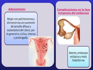 Adenomiosis: Complicaciones en la fase
temprana del embarazo
 