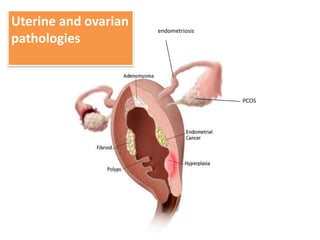 Uterine and ovarian
                      endometriosis
pathologies



                                      PCOS
 