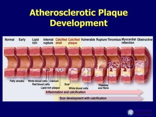 Atherosclerotic Plaque Development 