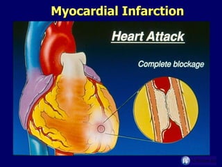 Myocardial Infarction 