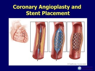 Coronary Angioplasty and  Stent Placement 