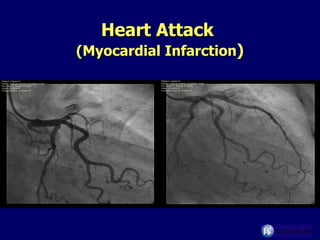 Heart Attack  (Myocardial Infarction ) 