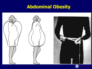 Abdominal Obesity 