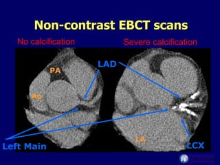 Non-contrast EBCT scans Left Main LAD LCX Ao LA PA No calcification Severe calcification 
