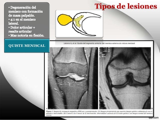 Lesion De Meniscos De Rodilla Cie 10