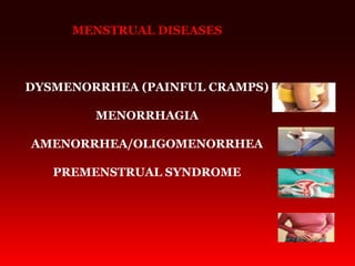MENSTRUAL DISEASES
DYSMENORRHEA (PAINFUL CRAMPS)
MENORRHAGIA
AMENORRHEA/OLIGOMENORRHEA
PREMENSTRUAL SYNDROME
 