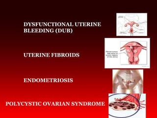UTERINE FIBROIDS
ENDOMETRIOSIS
POLYCYSTIC OVARIAN SYNDROME
DYSFUNCTIONAL UTERINE
BLEEDING (DUB)
 