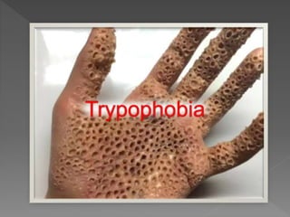 Trypophobia
 