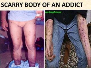 SCARRY BODY OF AN ADDICT
 