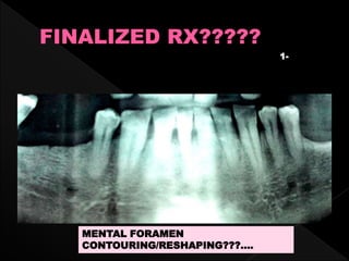 1-
MENTAL FORAMEN
CONTOURING/RESHAPING???....
 