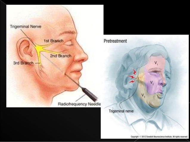 Case Ppt Mental Nerve Neuralgia