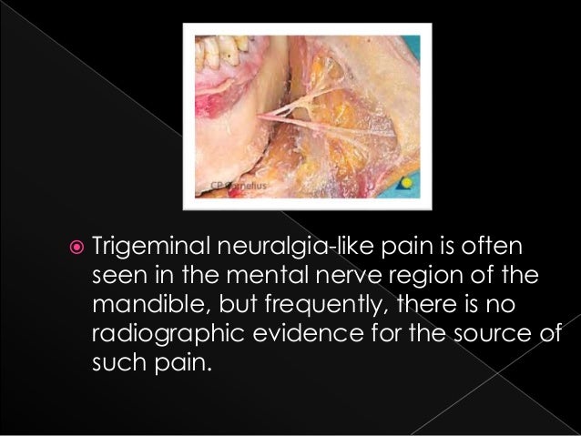 Case Ppt Mental Nerve Neuralgia