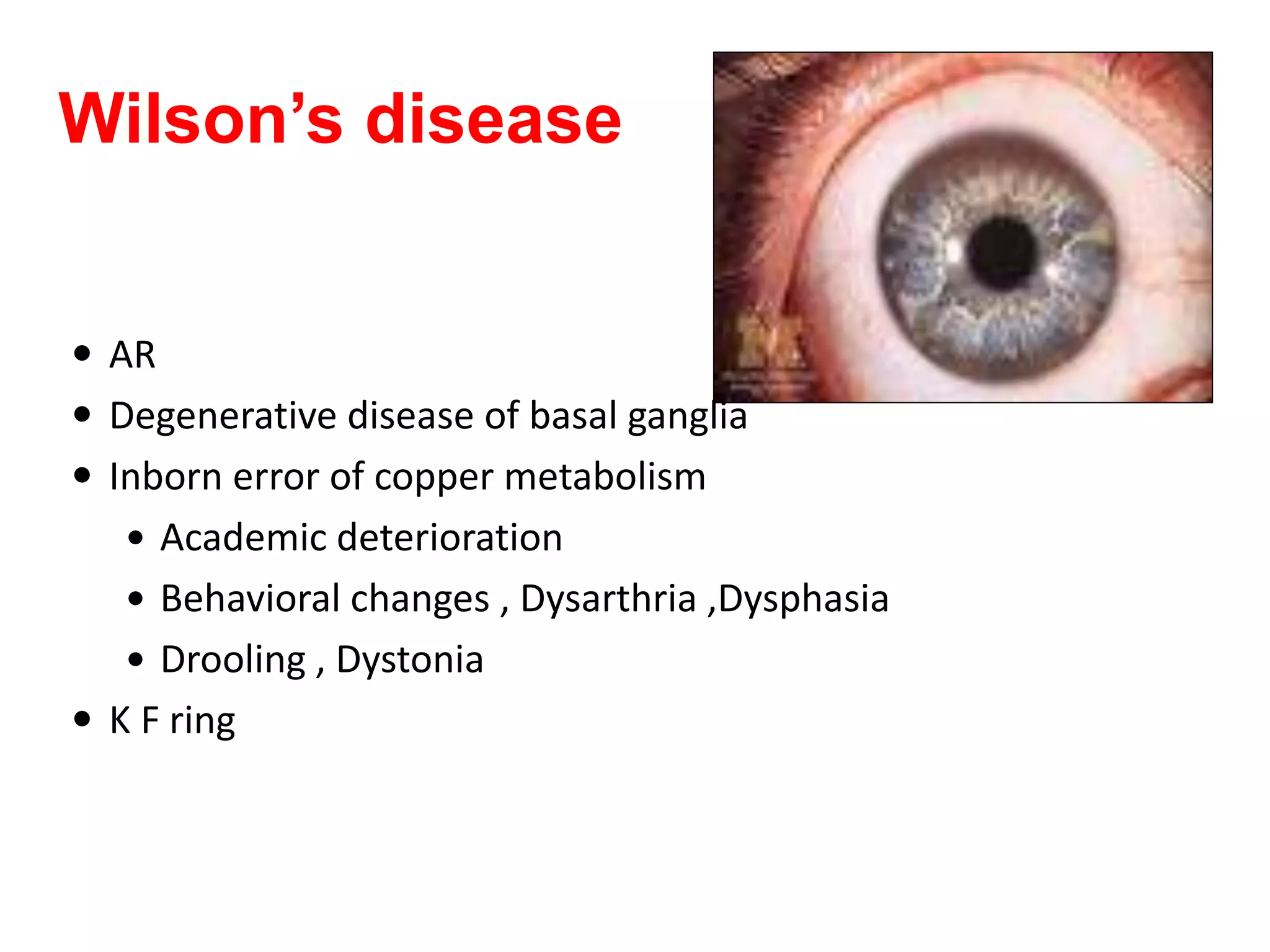 Wilson’s disease
 AR
 Degenerative disease of basal ganglia
 Inborn error of copper metabolism
 Academic deterioration
 Behavioral changes , Dysarthria ,Dysphasia
 Drooling , Dystonia
 K F ring
 