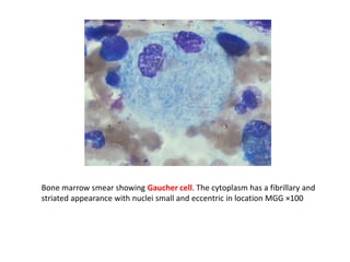 Bone marrow smear showing Gaucher cell. The cytoplasm has a fibrillary and
striated appearance with nuclei small and eccentric in location MGG ×100
 
