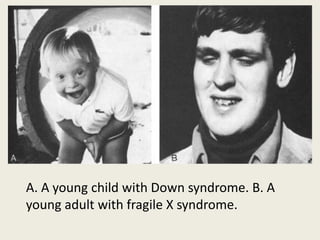A. A young child with Down syndrome. B. A
young adult with fragile X syndrome.
 