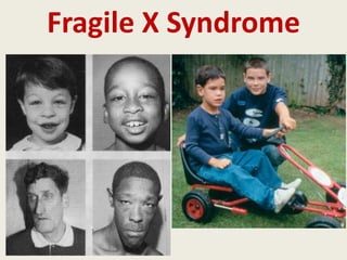 Fragile X Syndrome
 