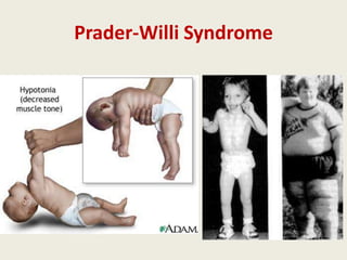 Prader-Willi Syndrome
 