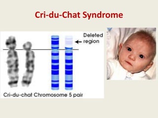 Cri-du-Chat Syndrome
 