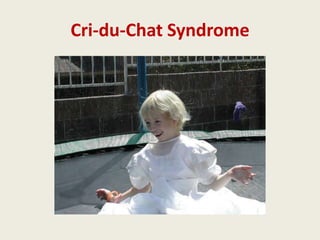 Cri-du-Chat Syndrome
 