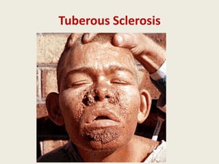 Tuberous Sclerosis
 
