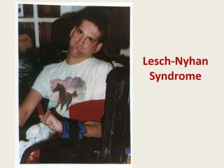 Lesch-Nyhan
 Syndrome
 